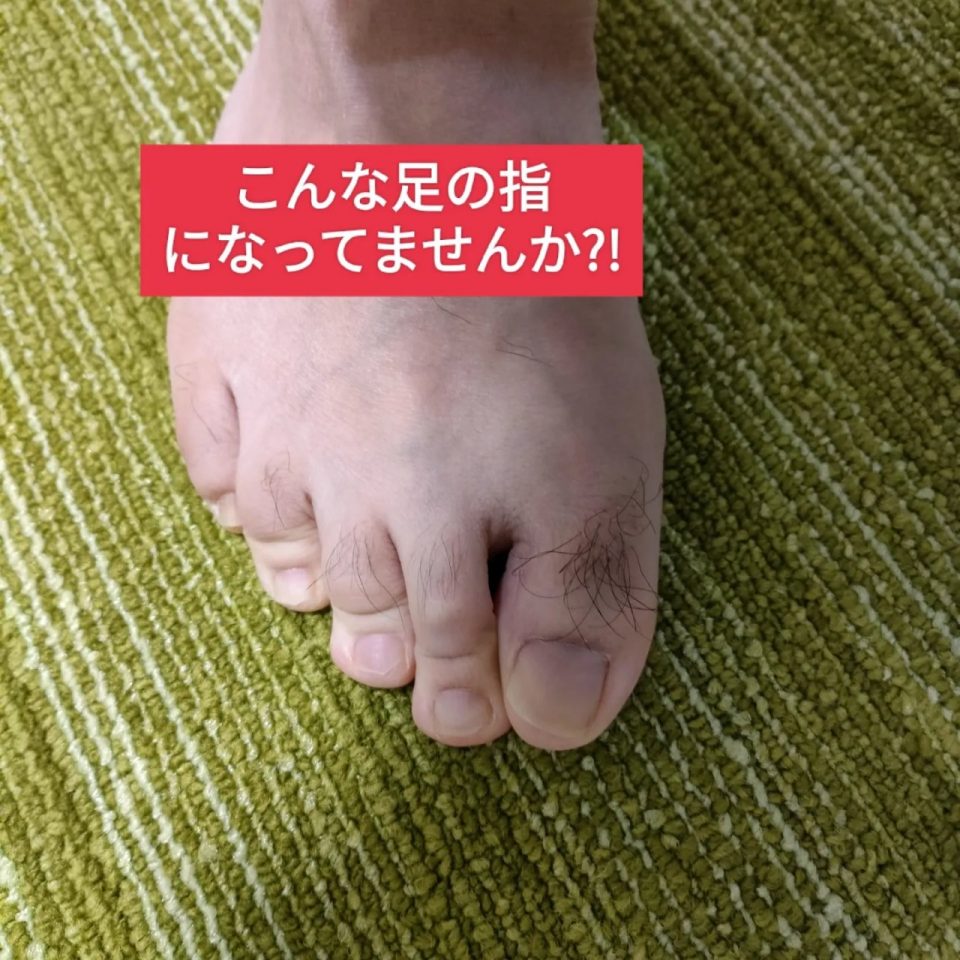 足底筋膜炎の特徴的な足の指の形